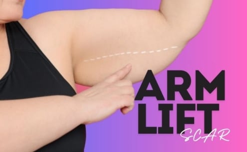 1 year arm lift scar 1 year arm lift scar
