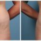 Liposuction Case #1 Front