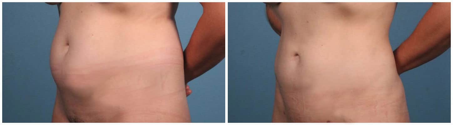 Liposuction Case #1 Left Oblique