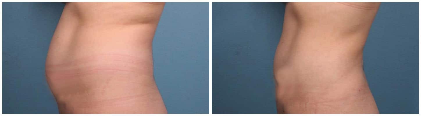 Liposuction Case #1 Left