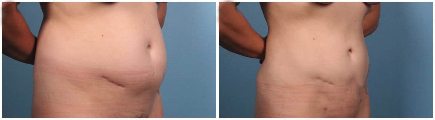 Liposuction Case #1 Front Right Oblique