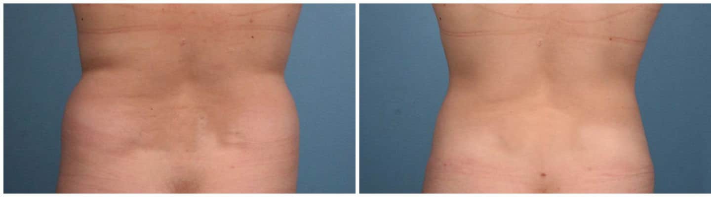 Liposuction Case #1 Back