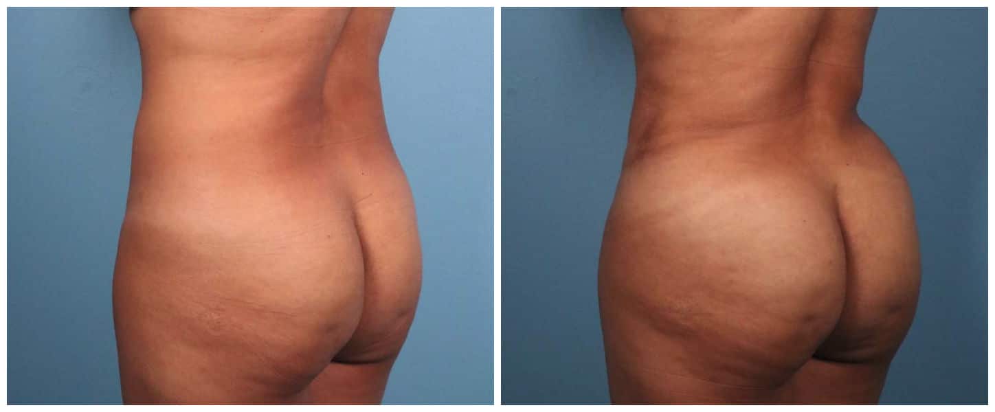 Brazilian Butt Lift Case #1 Back Left Oblique