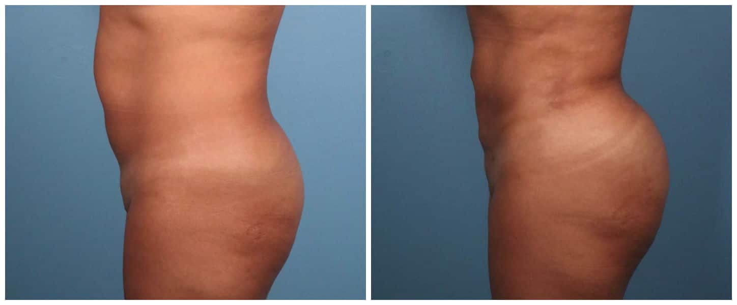 Brazilian Butt Lift Case #1 Left