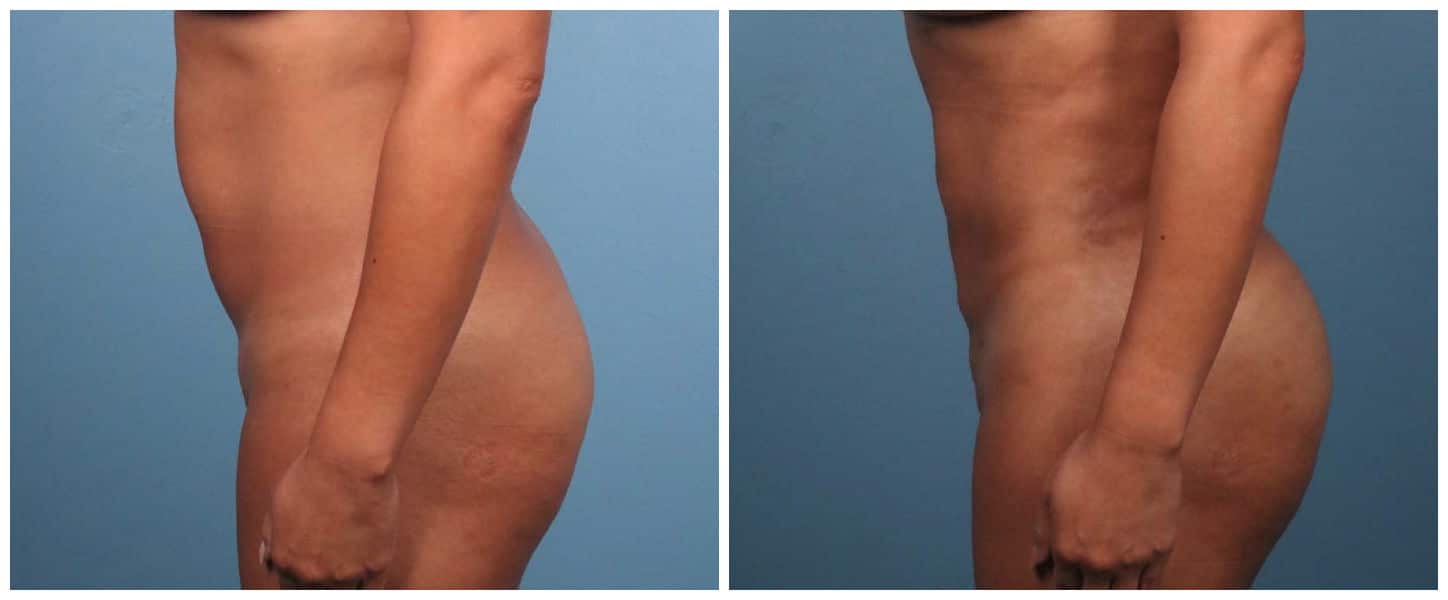 body-lipo-bbl-PG-6