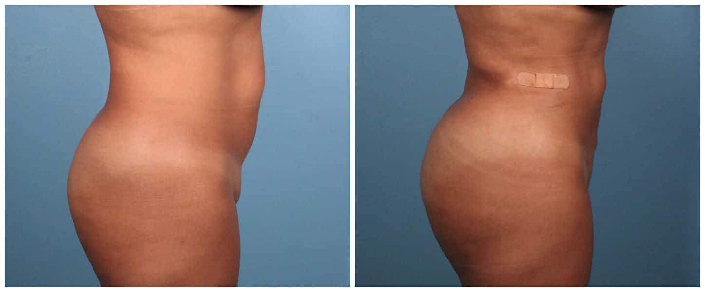 Brazilian Butt Lift Case #1 Right