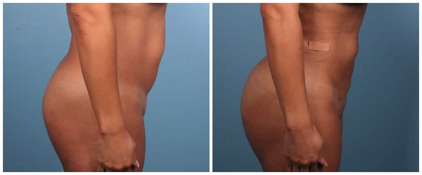 body-lipo-bbl-PG-8