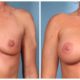 Breast Augmentation Case #1 Front
