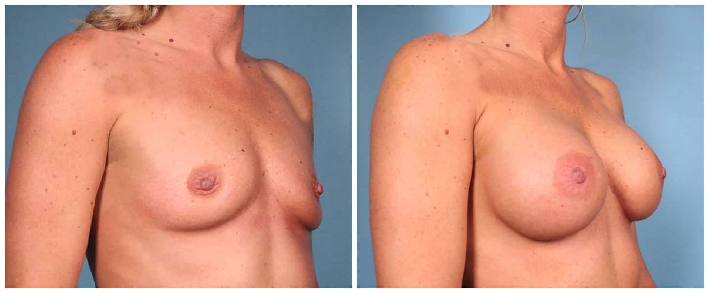 Breast Augmentation Case #1 Right Oblique
