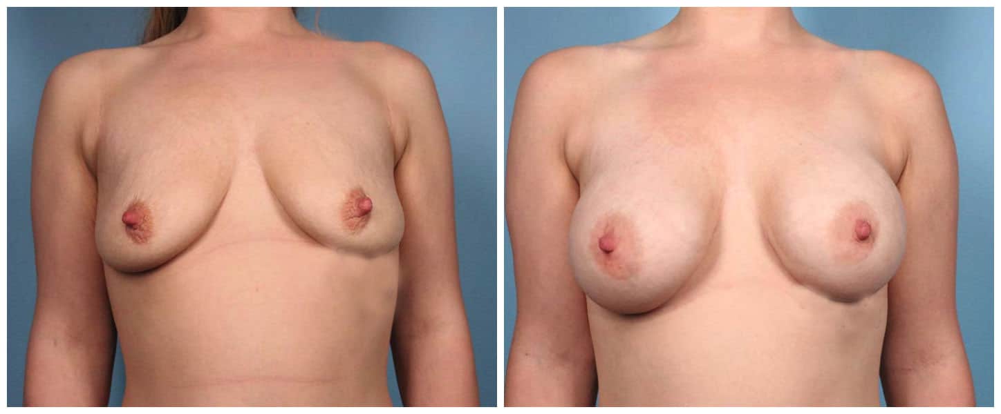Breast Augmentation Case #2 Front