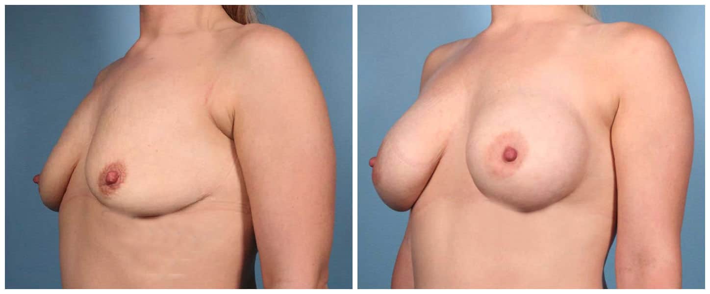 Breast Augmentation Case #2 Left Oblique