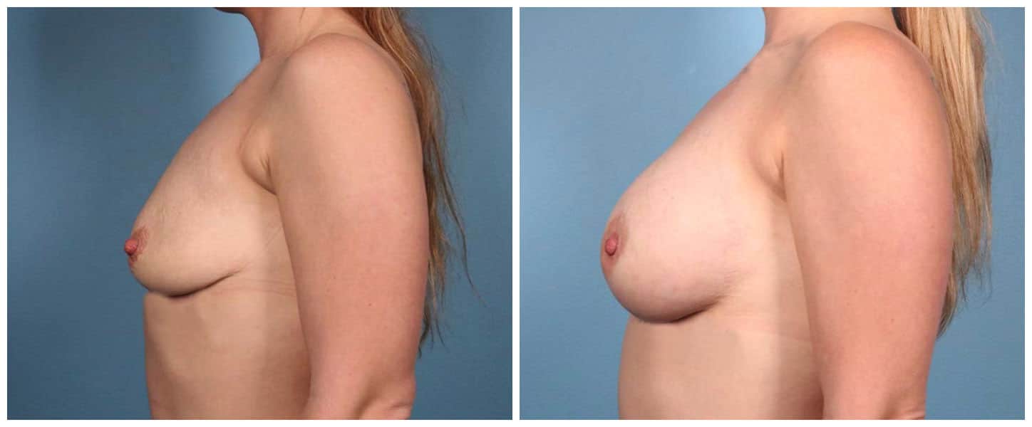 Breast Augmentation Case #2 Left