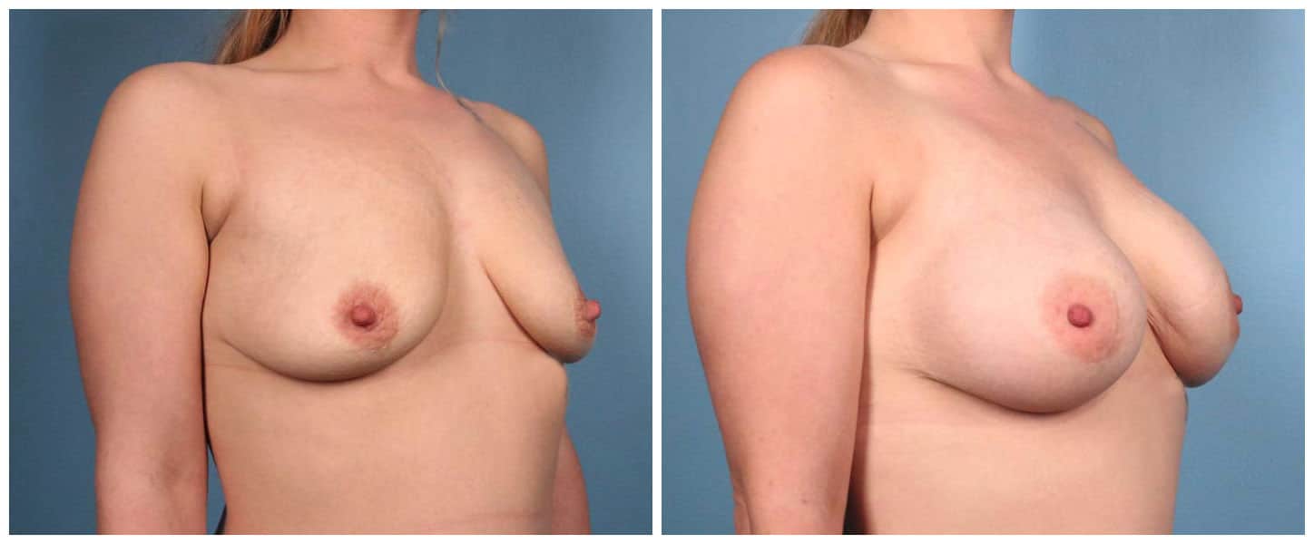 Breast Augmentation Case #2 Right Oblique