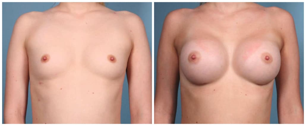 Breast Augmentation Case #3 Front