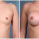 Breast Augmentation Case #3 Front