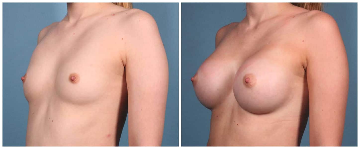Breast Augmentation Case #3 Left Oblique