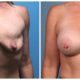 Breast Augmentation Case #4 Front