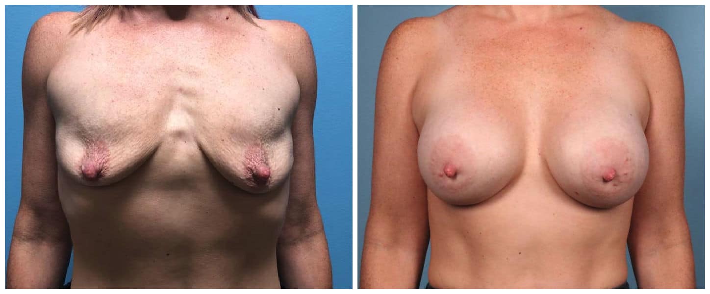 Breast Augmentation Case #4 Front