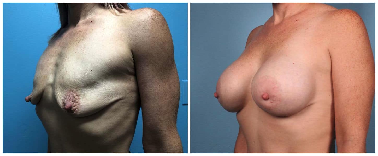 Breast Augmentation Case #4 Left Oblique