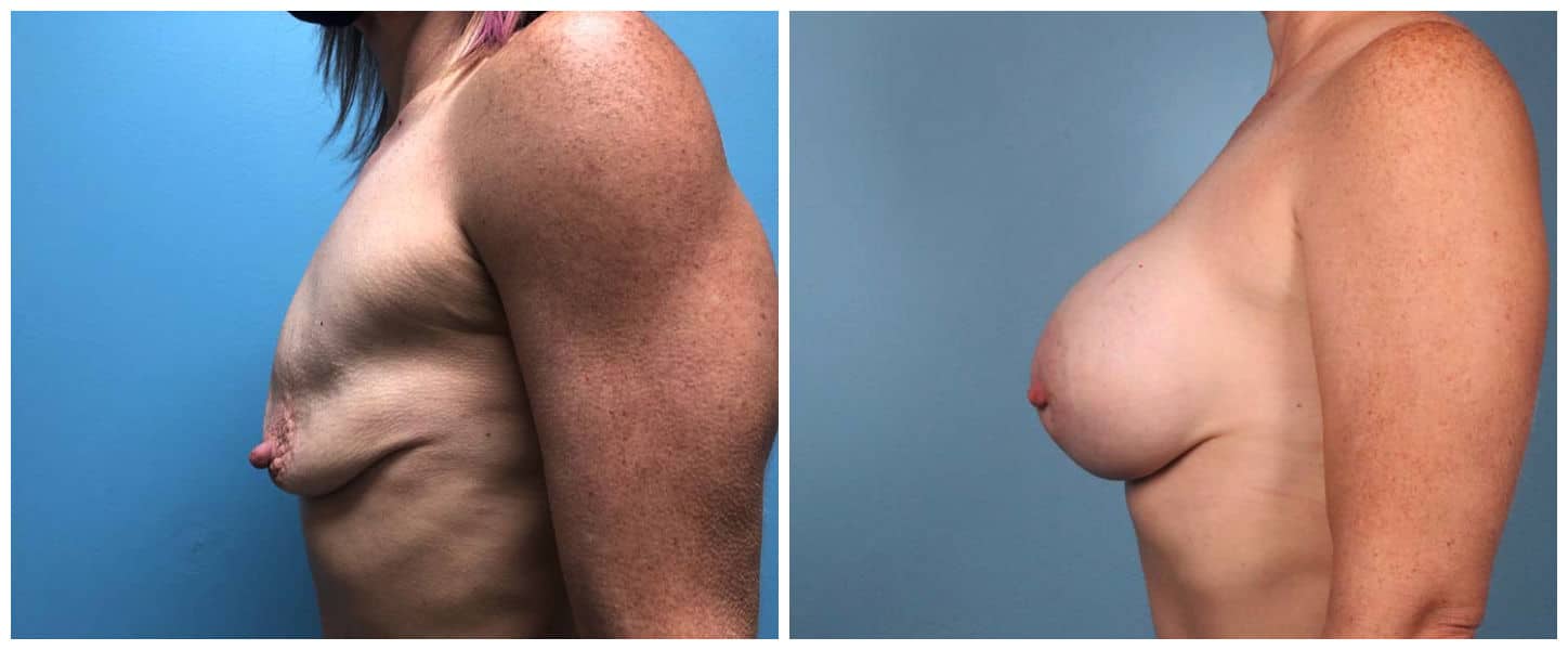 Breast Augmentation Case #4 Left