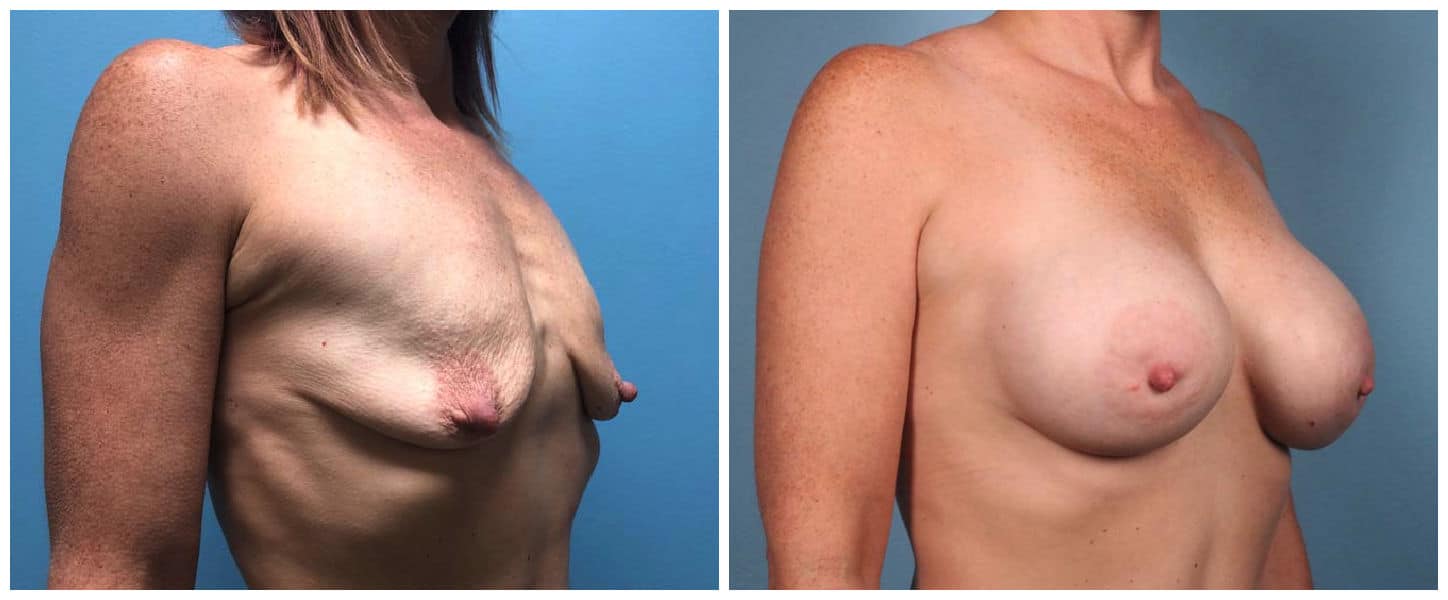 Breast Augmentation Case #4 Right Oblique