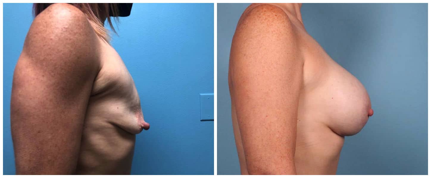 Breast Augmentation Case #4 Right