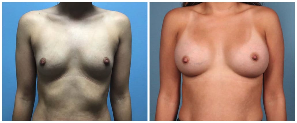Breast Augmentation Case #5 Front