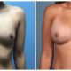 Breast Augmentation Case #5 Front