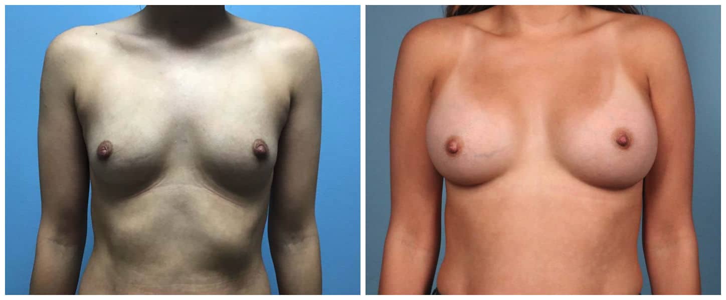 Breast Augmentation Case #5 Front