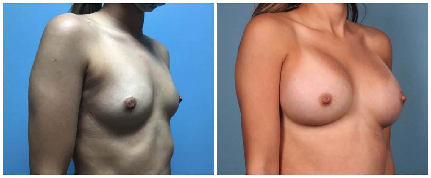 Breast Augmentation Case #5 Right Oblique