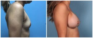BREAST IMPLANT SIZE