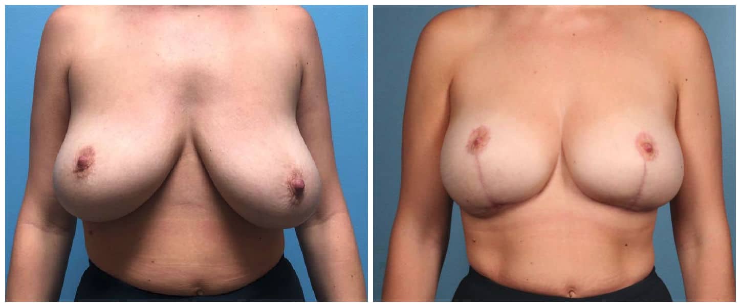 Breast Lift Case #1 Front
