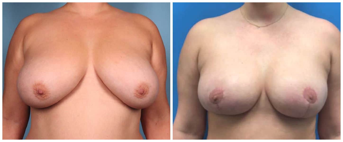 Breast Reduction Case #1 Front