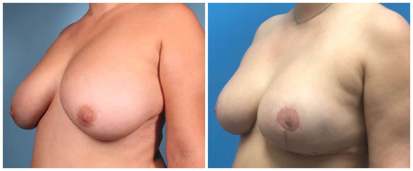 Breast Reduction Case #1 Left Oblique