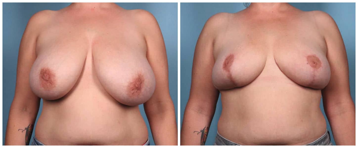 Breast Reduction Case #2 Front