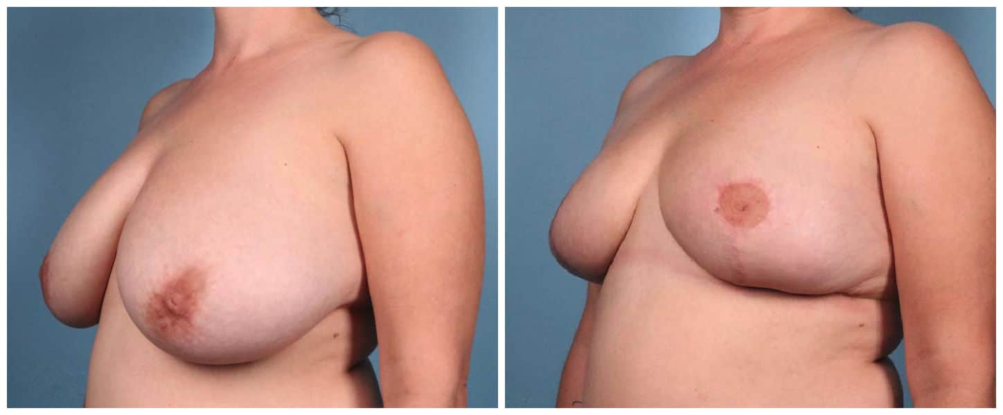 Breast Reduction Case #2 Left Oblique