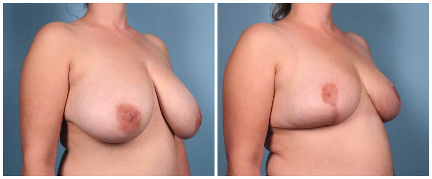Breast Reduction Case #2 Right Oblique