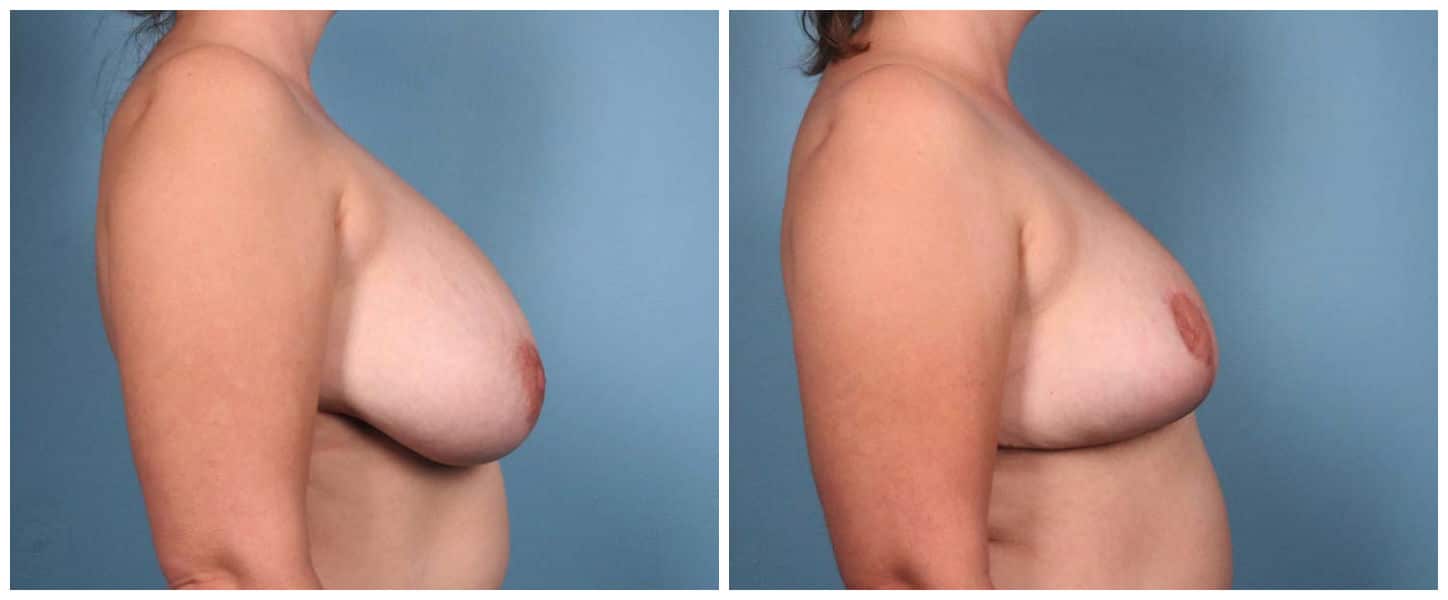 Breast Reduction Case #2 Right