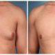 Gynecomastia Case #1 Front