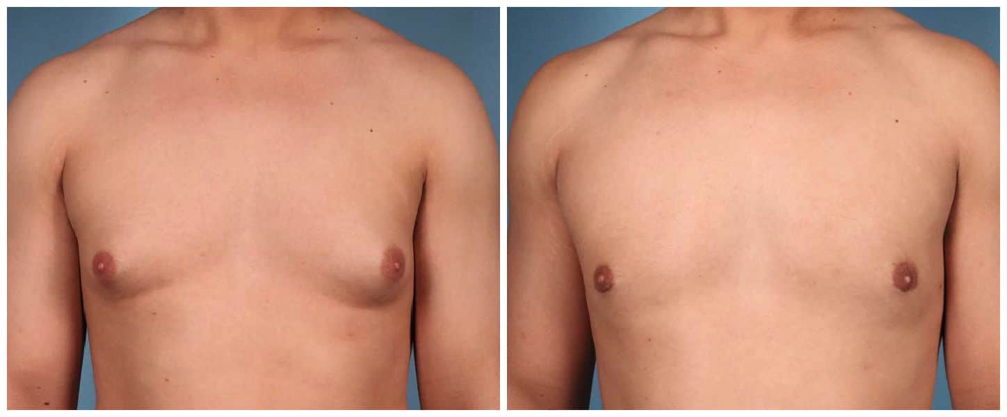 Gynecomastia Case #1 Front