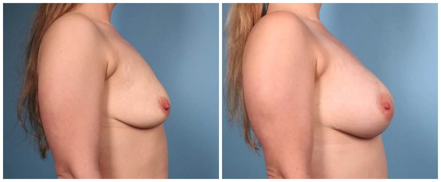 Breast Augmentation Case #2 Right