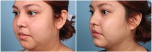 Double Chin Liposuction