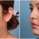 Liposuction Case #2 Left Oblique