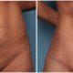 Tummy Tuck Case #1 Front
