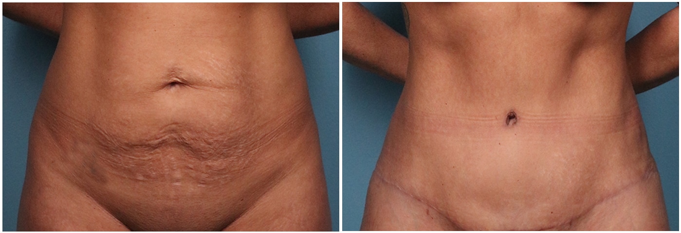 Tummy Tuck