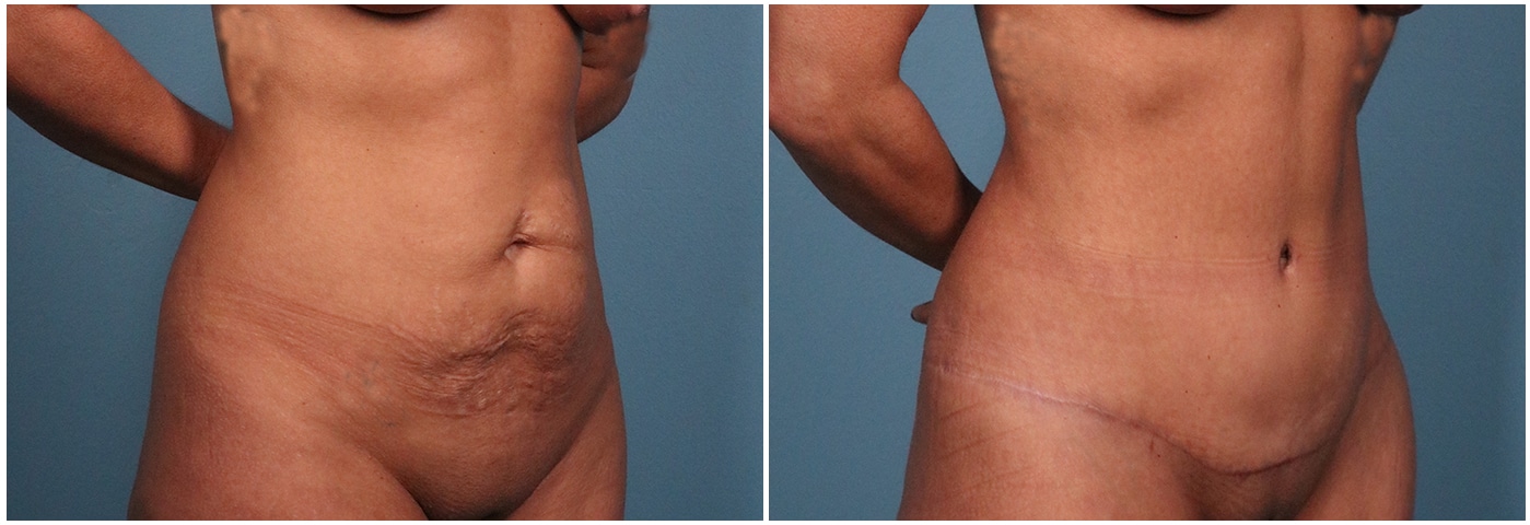 Tummy Tuck Case #1 Left Oblique
