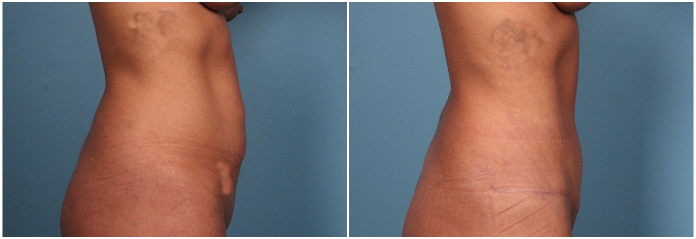 Tummy Tuck Case #1 Left