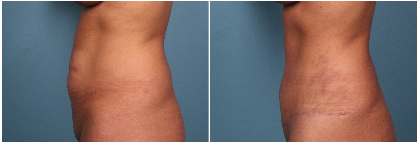 Tummy Tuck Case #1 Right