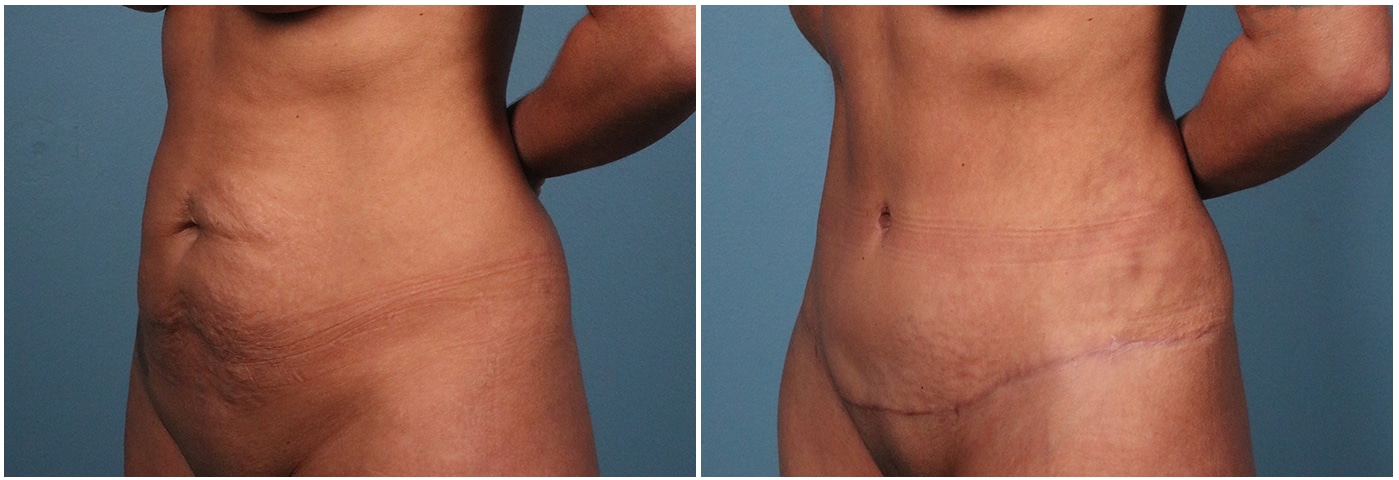 Tummy Tuck Case #1 Right Oblique