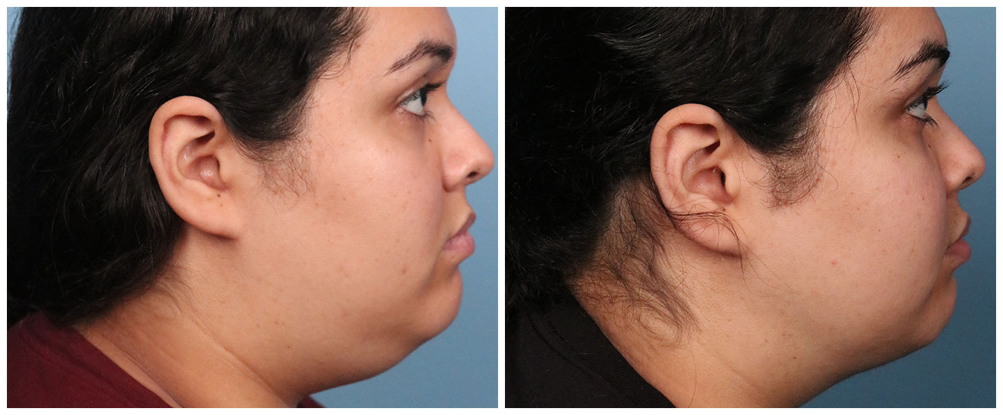 Liposuction Case #2 Right